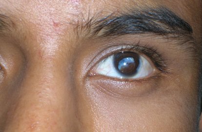 Cataract Surgeon in Gujarat